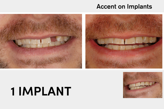 Dental Implant Before After 1