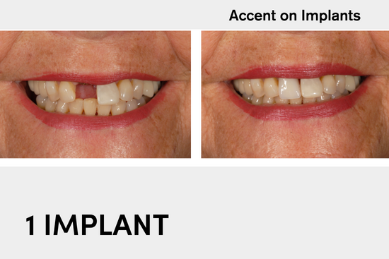 Dental Implant Before After 2