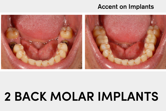 Accent Implants & Case Studies 2023