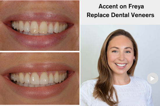 Freya Replace Dental Veneers